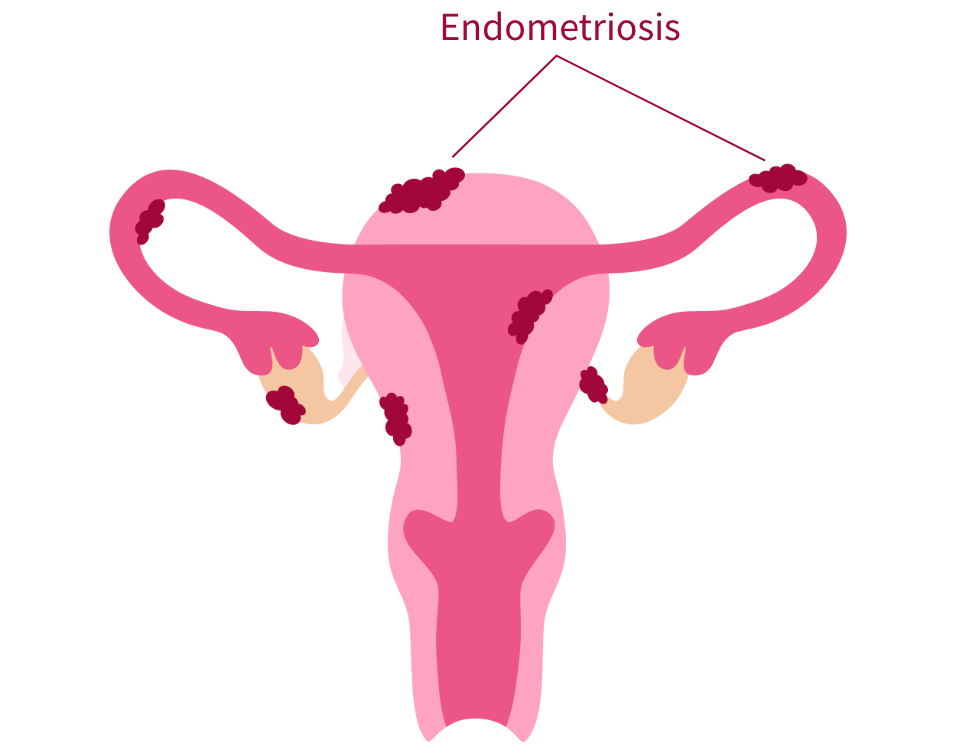 Illustration of uterus with endometriosis